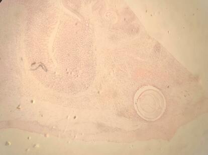 胃粘膜に潜り込んでいるアニサキス