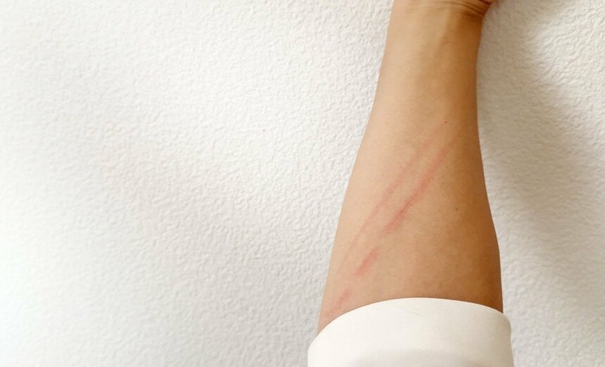 猫にひっかかれることで発症する「猫ひっかき病」って？