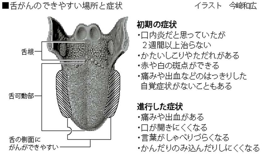 舌がんのできやすい場所と症状