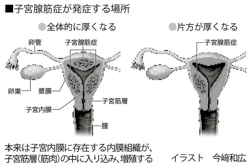 子宮腺筋症が発症する場所