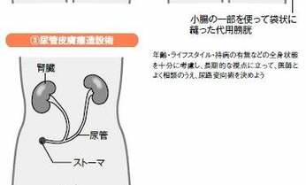 がんで膀胱を全摘したら、排泄はどうなる? 生活に支障は?