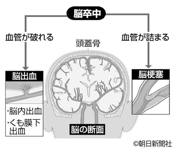 脳卒中のメカニズム（ｃ）朝日新聞社（週刊朝日　２０１８年３月１６日号より）