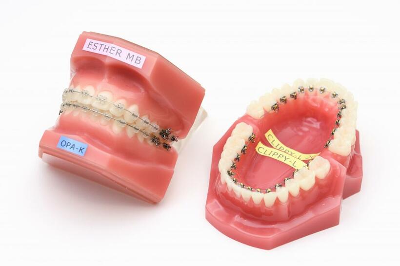 歯の表にブラケットをつけるのが一般的（左）。裏側は目立たないが、注意点もある（右）（撮影／写真部・掛祥葉子）