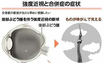 「ゆがんで見える」「中心が黒い」は要注意 失明リスクもある強度近視の合併症