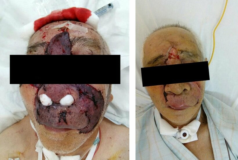 秋田市内の畑でクマの襲われた80代の男性。道端に落ちていた鼻を手術でくっつけた＝秋田大学医学部付属病院提供