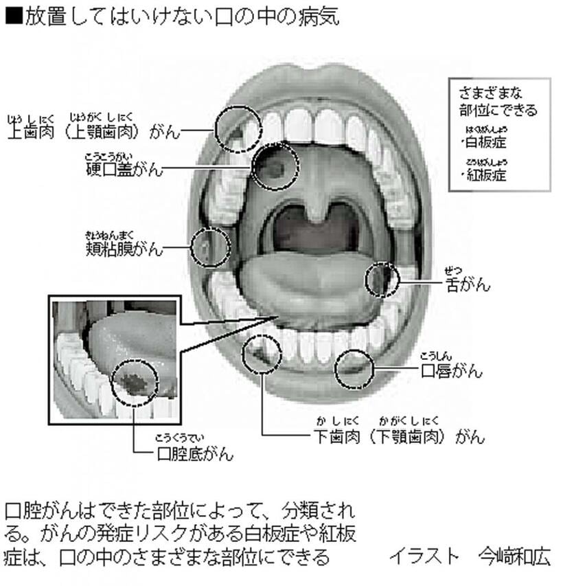 放置してはいけない口の中の病気