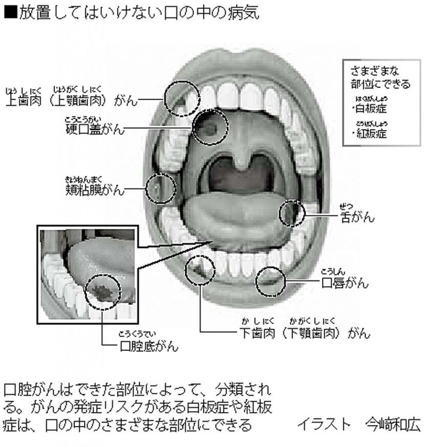 放置してはいけない口の中の病気