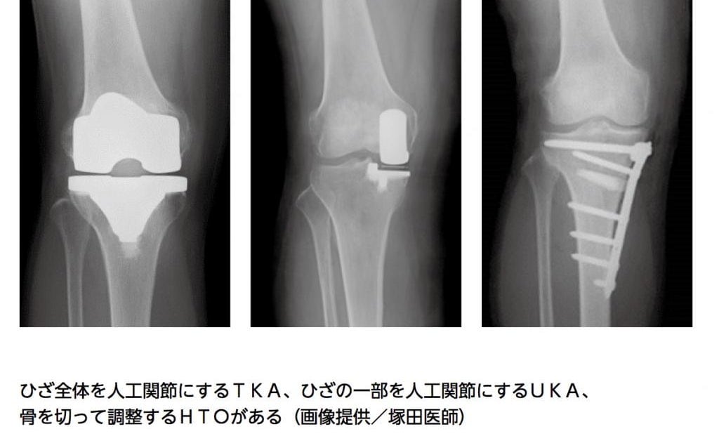 公式/送料無料 TKA・UKA 人工膝関節置換術パーフェクト - 本