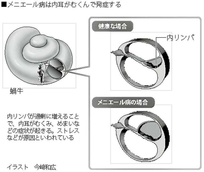 メニエール病は内耳がむくんで発症する