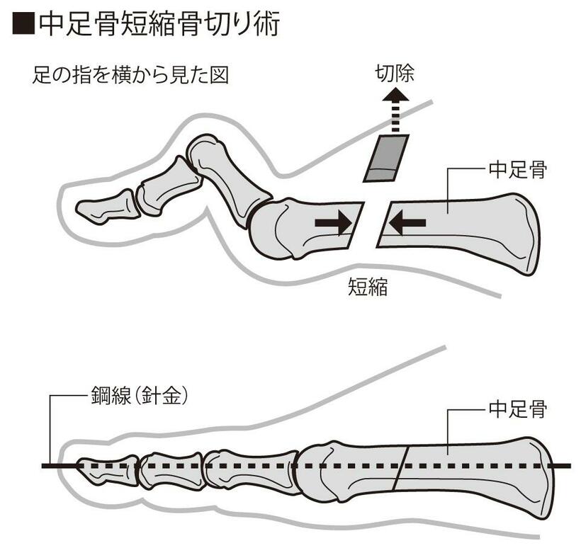 中足骨短縮骨切り術。中足骨の一部を切除して指の関節を温存する（イラスト・今﨑和広）