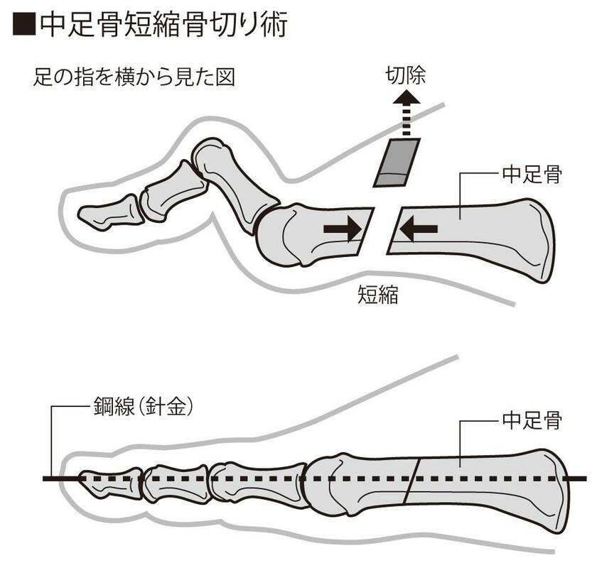 中足骨短縮骨切り術。中足骨の一部を切除して指の関節を温存する（イラスト・今﨑和広）