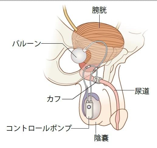 排尿後、バルーン内の生理食塩水が徐々にカフに戻り、１～２分後には元のように尿道を締める（イラスト／今崎和広）