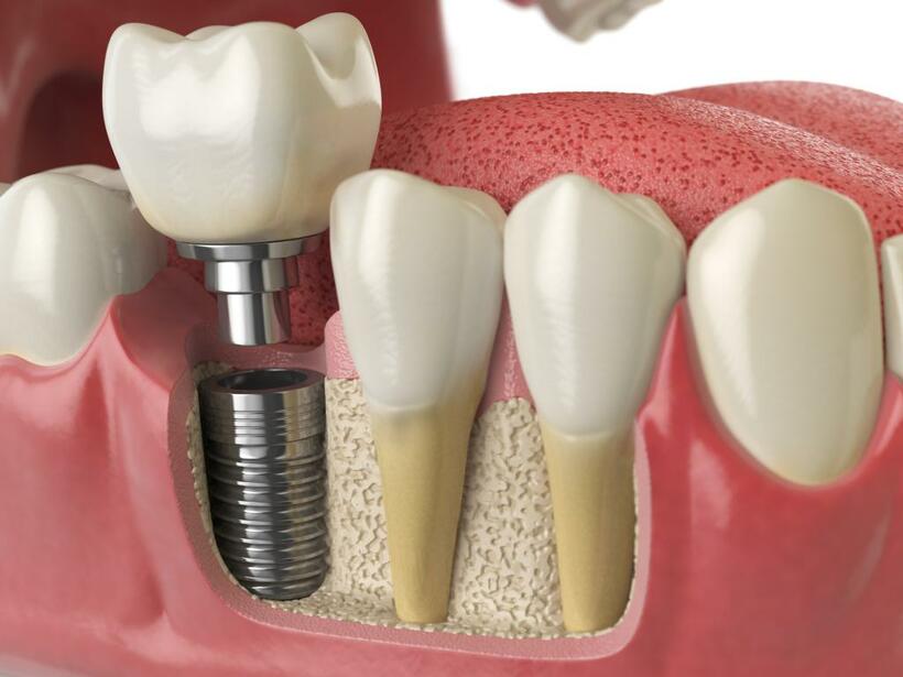 口の中が歯周病菌だらけの状態でインプラントを入れると、「インプラント周囲炎」という合併症を起こす危険が高い（写真：getty images）