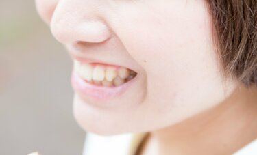 「歯ぎしり」しすぎで、かぶせものが壊れるって本当？　歯科医の答えは？　セラミックは割れやすいので注意