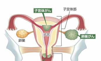 【子宮・卵巣がん手術】専門医に聞くセカンドオピニオンをとるべきケースは?