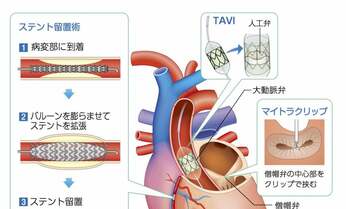 【心カテーテル治療】専門医に聞くセカンドオピニオンをとるべきケースは?