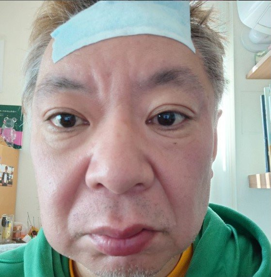右のほおが腫れた状態に(本人のインスタグラムから)