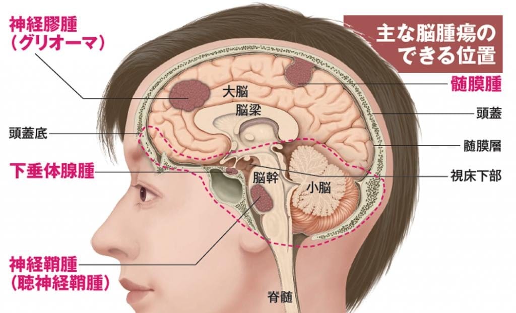 関ジャニ∞安田が脳腫瘍の一種「髄膜腫」摘出 予防は困難で視力や聴力に影響も | AERA dot. (アエラドット)