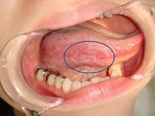 青線で囲んだ赤と白のポツポツが、初期舌がんの患部（提供：柴原孝彦教授）