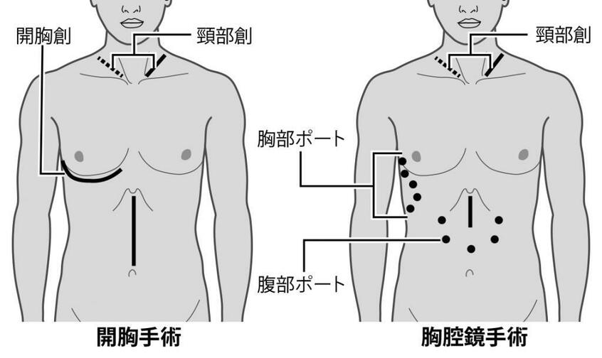 手術の切開位置(イラスト/今崎和広)※週刊朝日2021年4月23日号より