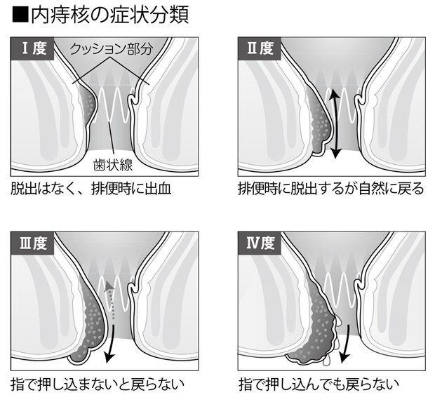 内痔核の症状分類　（週刊朝日　２０１８年８月１０日号より）