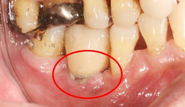 インプラント周囲炎によりインプラント周辺の歯槽骨が溶けて、歯肉が下がっている（提供：二階堂歯科医院・二階堂雅彦歯科医師）