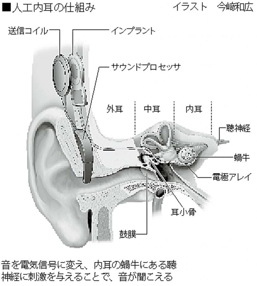 人工内耳の仕組み