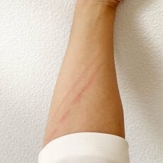 発症の7割は子ども「猫ひっかき病」ってどんな病気？　発熱や全身倦怠感が1カ月以上続くことも【専門家に聞く】