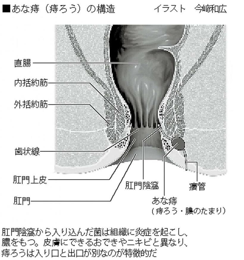 あな痔（痔ろう）の構造