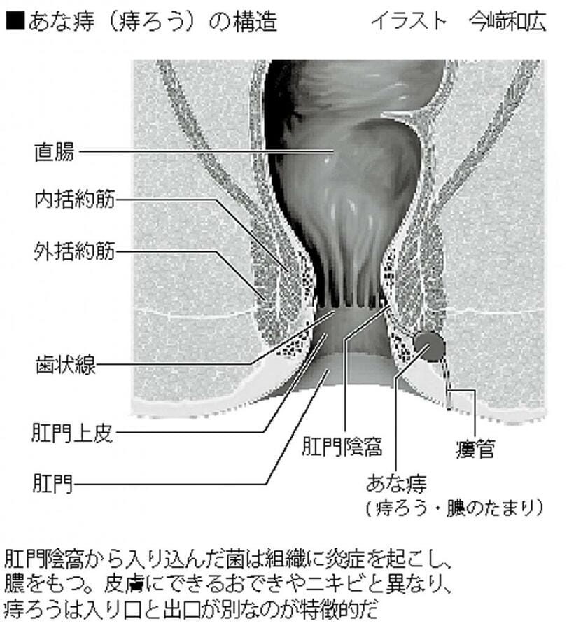 肛門に激痛、膿が出る！ 「あな痔」を放置するとがん化するケースも | AERA dot. (アエラドット)