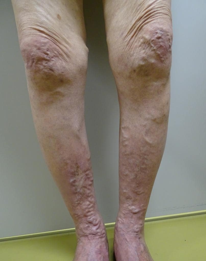 大伏在静脈瘤を発症した女性の足。左右のふくらはぎの痛みとふくらはぎの皮膚炎によるかゆみ（右足）があり、治療を実施した（横浜南共済病院　孟医師提供）
