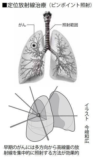 定位放射線治療（ピンポイント照射）（週刊朝日　２０１８年６月２２日号より）