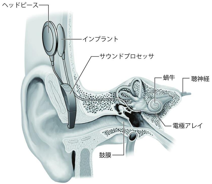 サウンドプロセッサが音を電気信号に変換し、インプラントに送信する。蝸牛に挿入した電極により聴神経から脳に信号を伝えることで音として認識する（イラスト／今崎和広）