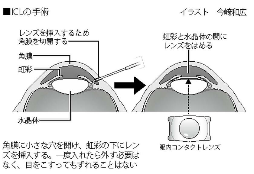 ICLの手術