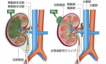 【腎がん手術】専門医に聞くセカンドオピニオンをとるべきケースは?