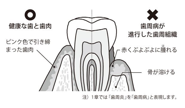健康な歯と歯肉と、歯周病が進行した歯周組織の違い（『日本人はこうして歯を失っていく』より）