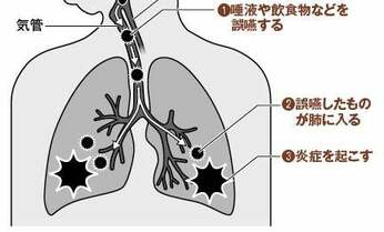 口内細菌が肺に垂れ流し 気づかぬまま進行する誤嚥性肺炎