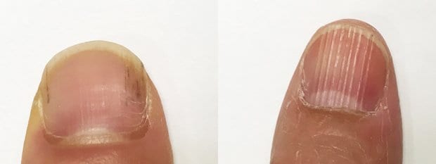 左の爪の写真は黒い線が入っており、右は縦線がくっきり出ている（東京医療専門学校提供）