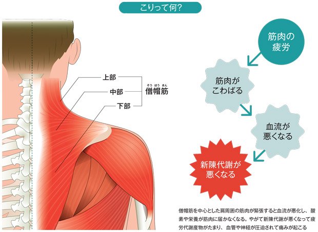 僧帽筋を中心とした肩周囲の筋肉が緊張すると血流が悪化し、酸素や栄養が筋肉に届かなくなる。やがて新陳代謝が悪くなって疲労代謝産物がたまり、血管や神経が圧迫されて痛みが起こる
