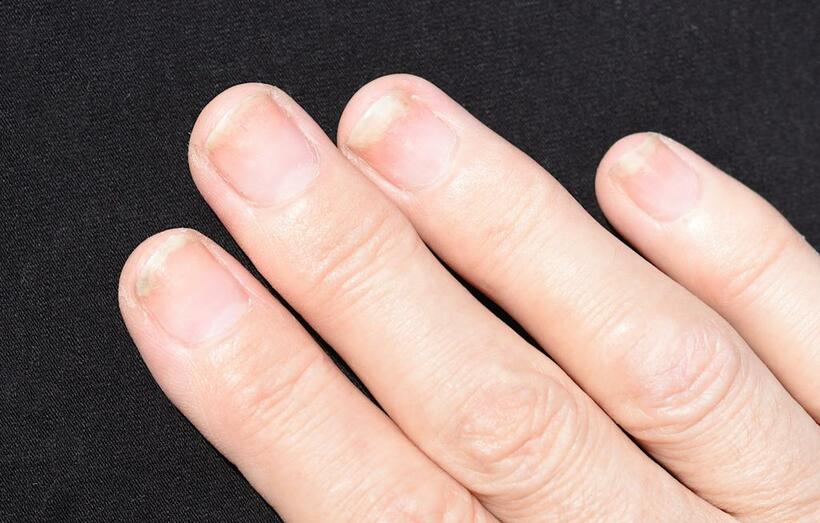 カビの感染で起きる爪甲剥離症（写真／Getty Images）