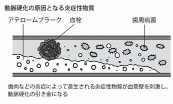 心筋梗塞や脳梗塞患者の多くは歯周病にかかっている 血管に悪さをする