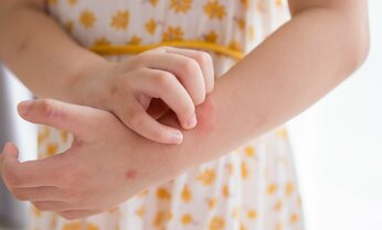 中学受験の勉強によるストレスで「皮膚炎」が悪化することも 専門医に聞く、子どもの夏の皮膚トラブル