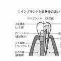 「インプラントは高い」は誤解? 治療費の理由とコスパ