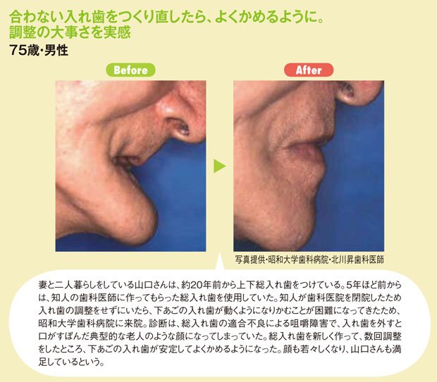 合わない入れ歯をつくり直したら、よくかめるように。調整の大事さを実感