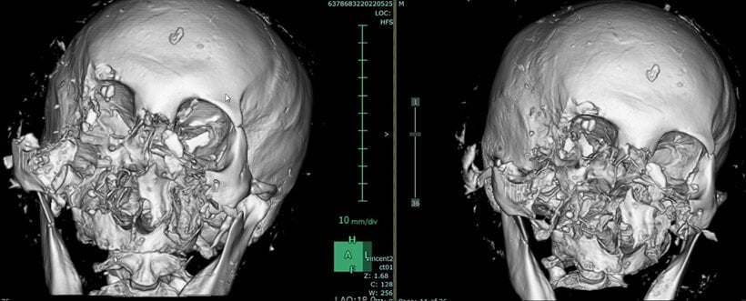 クマに襲われて顔面を粉砕された男性のCT画像＝秋田大学医学部付属病院提供