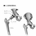 千原ジュニアが受ける難病「特発性大腿骨頭壊死症」の手術の進化 術後は痛みのない生活が可能に