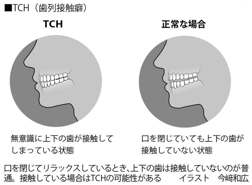 TCH（歯列接触癖）