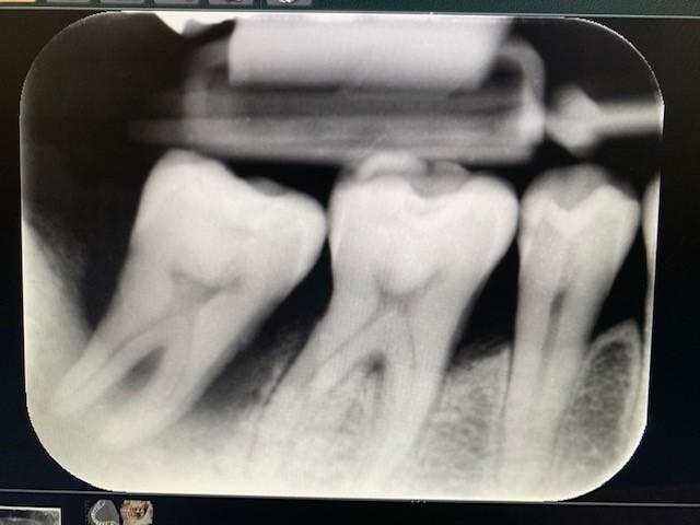 重度の歯周病のX線写真、下のほうで二股に分かれているのが歯の根で、その周囲にうつっている網目状の白い部分が歯を支えている歯槽骨。健康な歯では表に出ている白い歯（エナメル質）の少し下あたりから歯槽骨が見える。この患者の場合、骨の破壊がかなり進んでおり、治療をしても歯を保存することは難しい（写真提供・若林医師）  