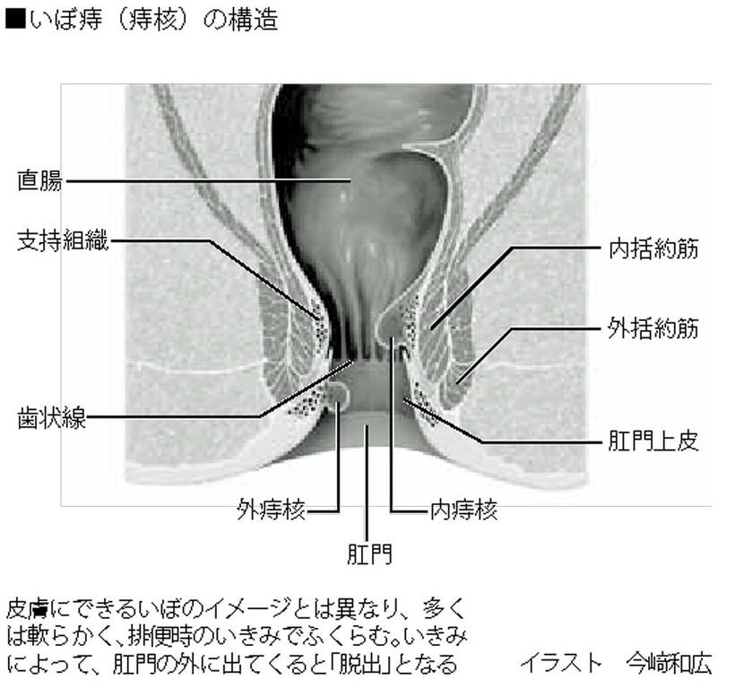 いぼ痔（痔核）の構造