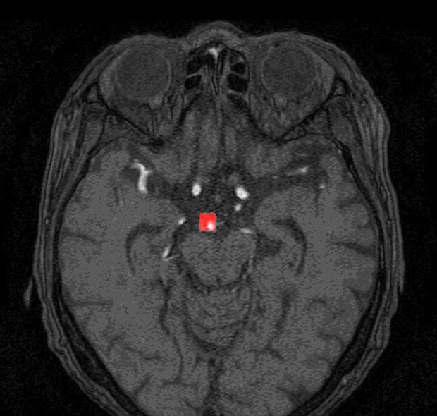 エルピクセルが開発を進めるシステムは、ＭＲＩの検査画像から脳動脈瘤を自動的に検出して、赤色の目印をつける。写真は、頭部を目から後頭部にかけて切った断面の画像。脳の中央付近の目印がわかる（写真提供：エルピクセル）